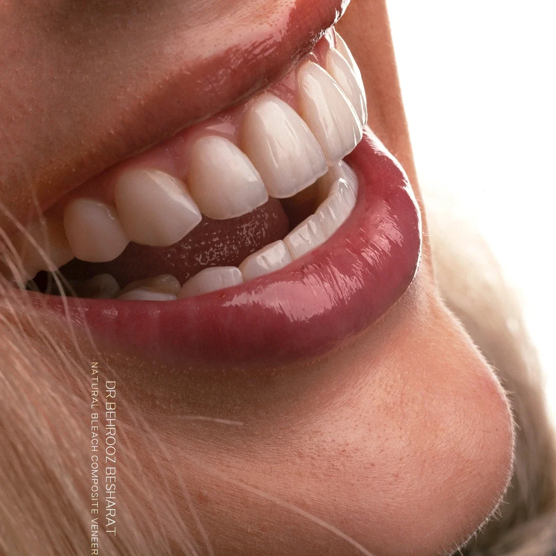 کامپوزیت دندان یا لمینت؟ بهترین انتخاب برای لبخند شما! تفاوت کامپوزیت دندان و لمینت دندان: