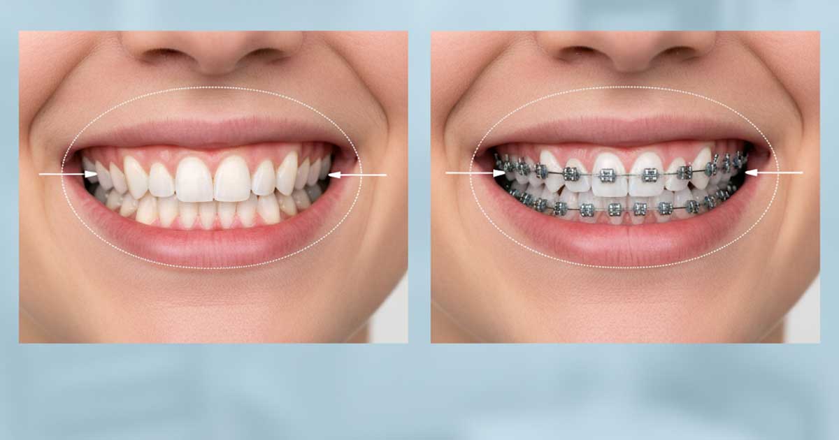 چرا برای ارتودنسی دندان را میکشند؟