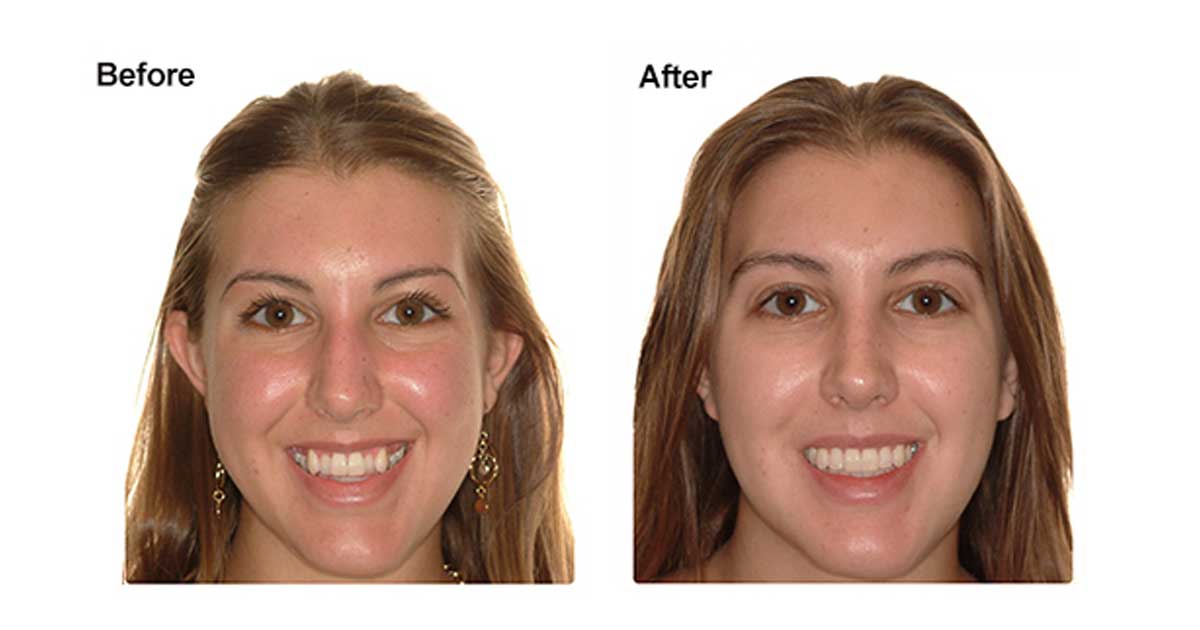 چرا برای ارتودنسی دندان را میکشند؟