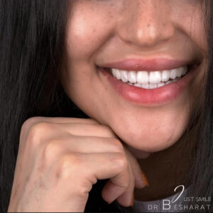 کامپوزیت دندان یا لمینت؟ بهترین انتخاب برای لبخند شما!