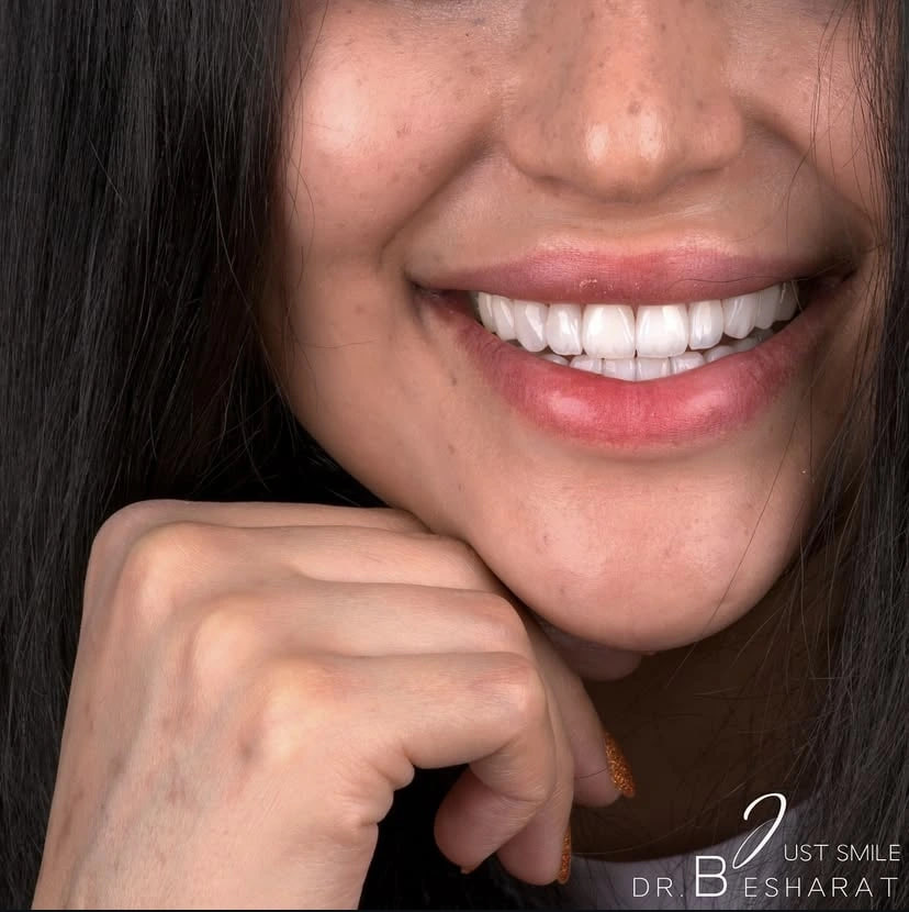 کامپوزیت دندان یا لمینت؟ بهترین انتخاب برای لبخند شما!