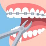 چرا برای ارتودنسی دندان را میکشند؟ 