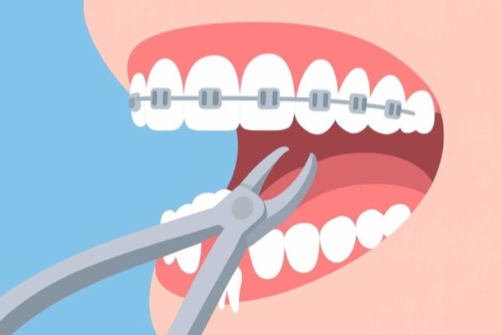 چرا برای ارتودنسی دندان را میکشند؟ 