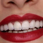 لمینت دندان در کرج | تجربه‌ای مطمئن برای لبخندی طبیعی و درخشان