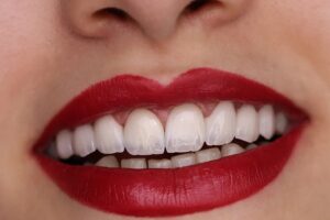 لمینت دندان در کرج | تجربه‌ای مطمئن برای لبخندی طبیعی و درخشان