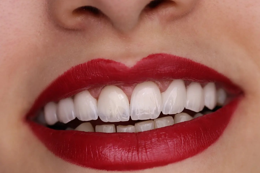 لمینت دندان در کرج | تجربه‌ای مطمئن برای لبخندی طبیعی و درخشان