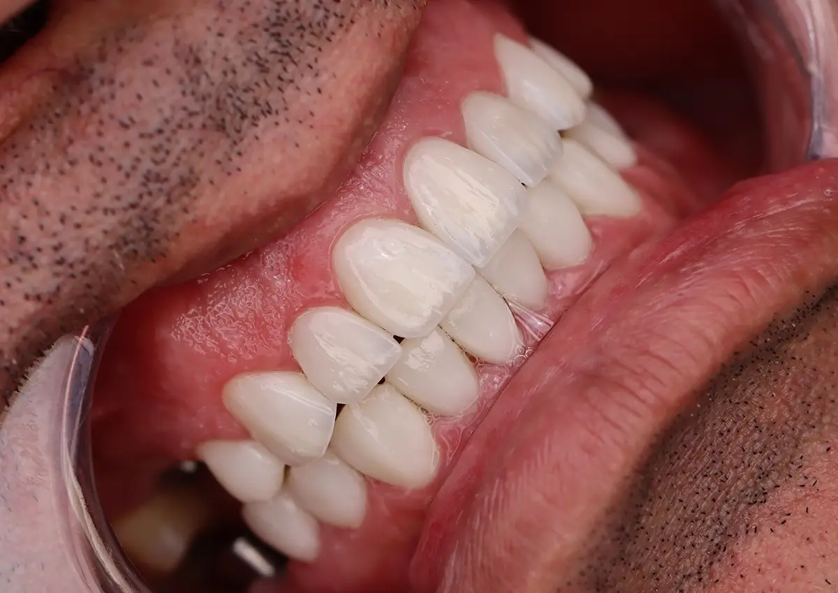 لمینت دندان اقساطی در کرج