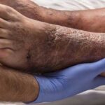 بی‌دردی زخم در افراد دیابتی نشانه پیشرفت آسیب عصبی است