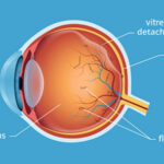 جداشدگی زجاجیه خلفی چیست و چرا ناگهان مگس‌پران می‌بینید؟