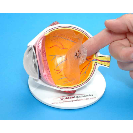 جداشدگی زجاجیه خلفی, تشخیص جداشدگی زجاجیه