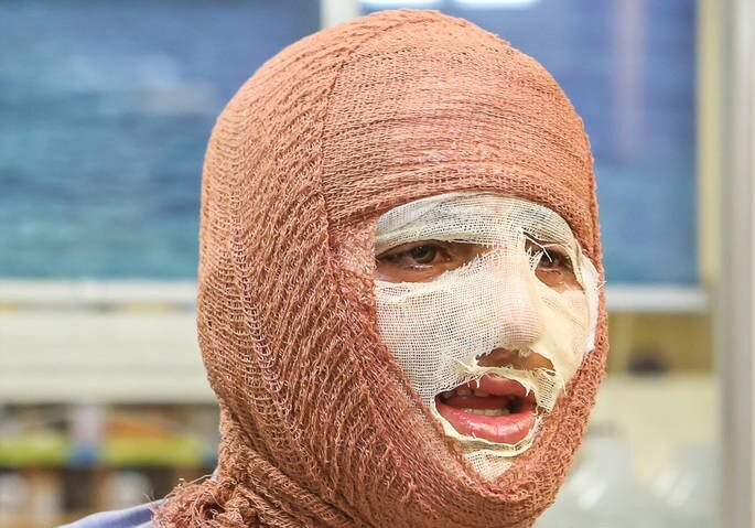 جلالی: سالانه حدود ۳۰۰ هزار نفر به مراکز سوختگی کشور مراجعه می‌کنند