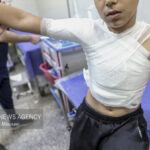 حادثه ای دردناک به نام «سوختگی» در ایران!