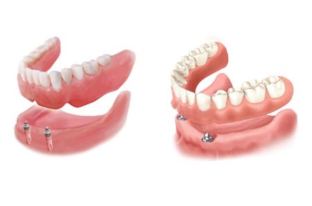 خداحافظی با لقی دندان مصنوعی