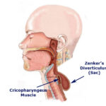 دیورتیکولوم زنکر؛ علت، علائم و درمان مدرن بدون جراحی باز