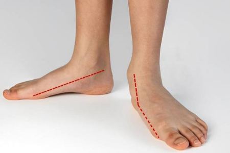 علائم هشداردهنده انحراف زانو ناشی از کف پای صاف