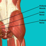 رهایی از درد مزمن کف لگن؛ داستان واقعی بهبود از نورالژی پودندال