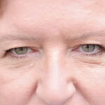 مشکلات رایج پلک که با افزایش سن ظاهر می‌شوند + درمان آن‌ها