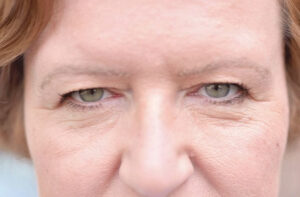 مشکلات رایج پلک که با افزایش سن ظاهر می‌شوند + درمان آن‌ها