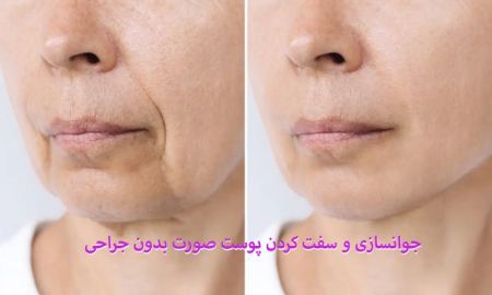 جوانسازی و سفت کردن پوست صورت بدون جراحی جوانسازی و سفت کردن پوست صورت بدون جراحی