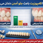 آیا کامپوزیت باعث جلو آمدن دندان میشود