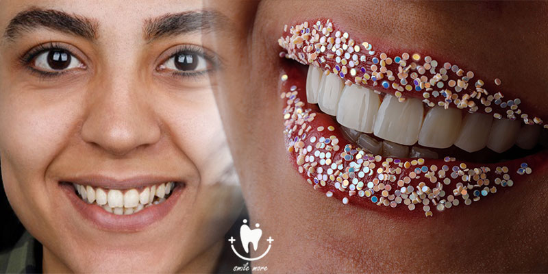 چگونه از جلو آمدن دندان بعد از کامپوزیت جلوگیری کنیم؟