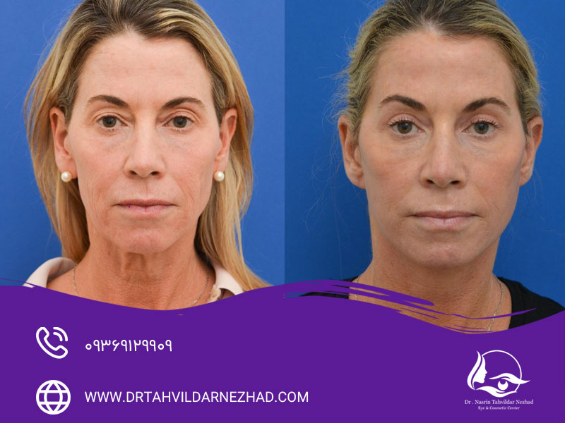 تأثیر کمپرس سرد و گرم بر کاهش تورم و کبودی ناشی از بلفاروپلاستی