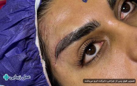 لیفت دایرکت ابرو