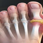 داروهای نقرس به سلامت قلب نیز کمک می‌کنند