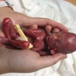 سقط جنین؛ از «صنعت پول‌های سیاه» تا عوارض جبران‌ناپذیر جسمی و روانی