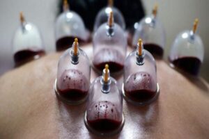 حجامت توسط افراد غیر متخصص خطرناک است