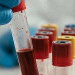 پیش بینی خطر عود سرطان خون با آزمایش ژنتیک