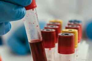 پیش بینی خطر عود سرطان خون با آزمایش ژنتیک