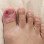 علل و نشانه های بروز عفونت ناخن پا می شود؟