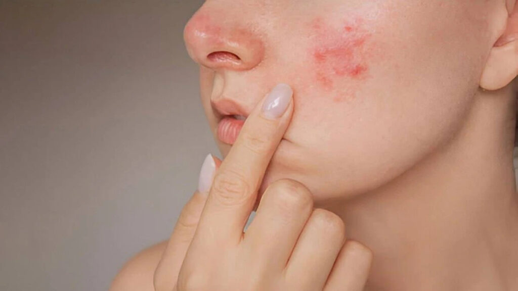 آیا کراتین باعث جوش و آکنه می شود؟