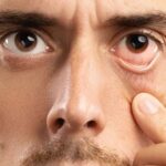 روش‌های فوری کاهش پف و تیرگی زیر چشم