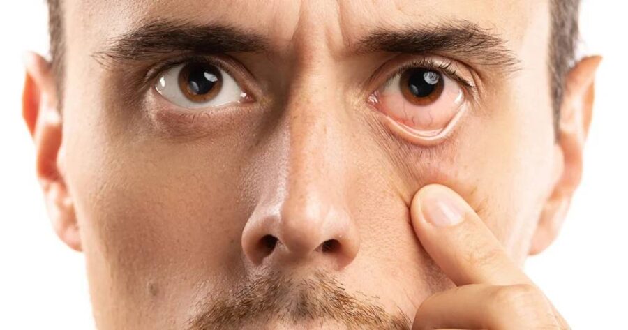 روش‌های فوری کاهش پف و تیرگی زیر چشم