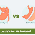 اسلیو معده یا بای پس معده؛ کدام روش برای کاهش وزن مؤثرتر است؟