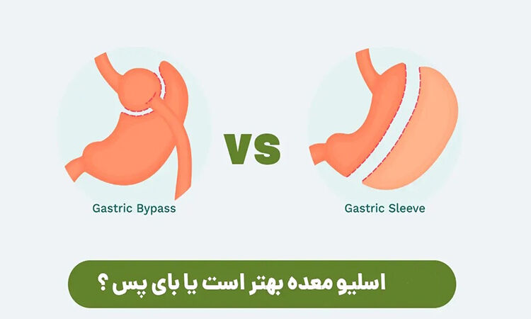 اسلیو معده یا بای پس معده؛ کدام روش برای کاهش وزن مؤثرتر است؟