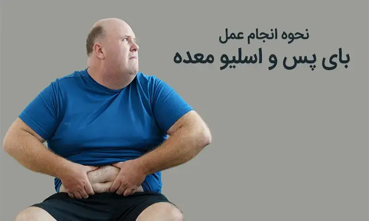 نحوه انجام عمل بای پس معده و اسلیو معده 