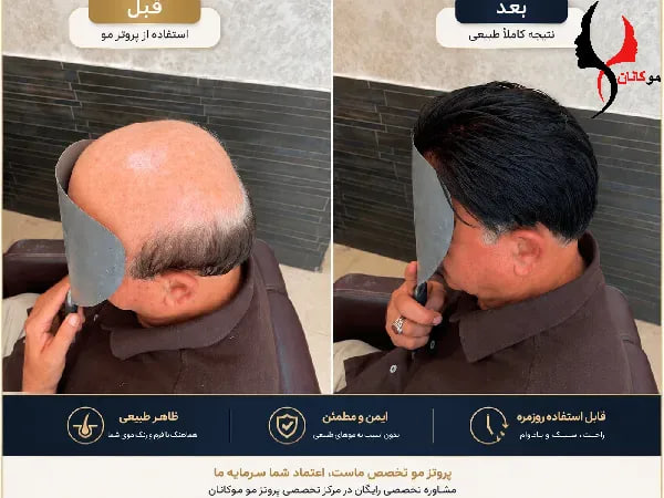 پروتز مو در MRI یا سی تی اسکن مشکل ایجاد می کند