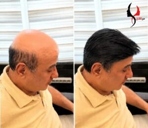 پروتز مو در MRI یا سی تی اسکن مشکل ایجاد می کند