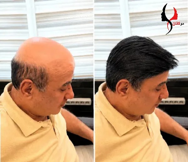 پروتز مو در MRI یا سی تی اسکن مشکل ایجاد می کند