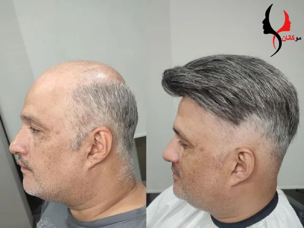پروتز مو در MRI یا سی تی اسکن مشکل ایجاد می کند
