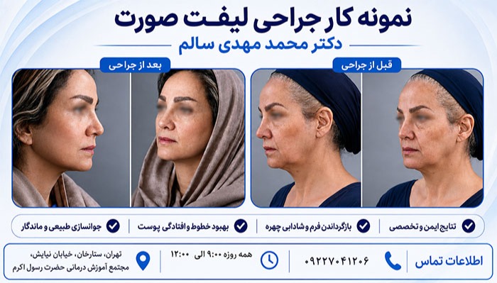 نمونه نتایج جراحی لیفت صورت دکتر محمدمهدی سالم