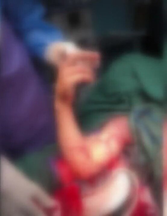 یک جراحی کم‌نظیر در بروجرد؛ دست قطع‌شده نوجوان دوباره به بدن بازگشت