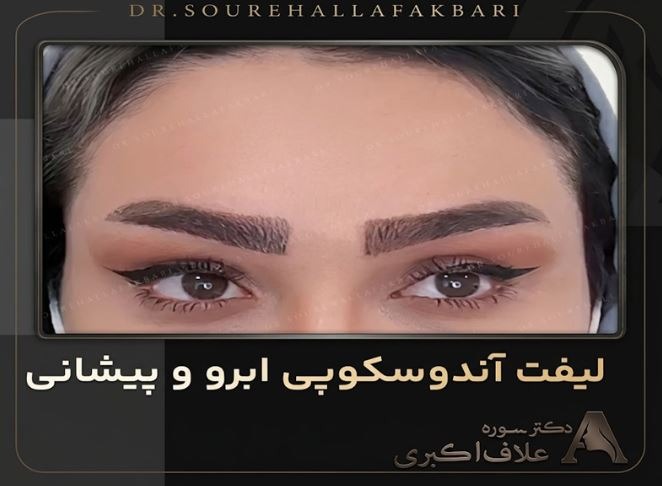 لیفت اندوسکوپیک ابرو و پیشانی