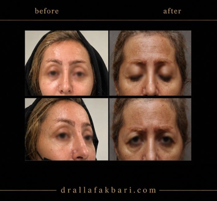 قبل و بعد لیفت اندوسکوپیک ابرو و پیشانی توسط دکتر سوره علاف اکبری